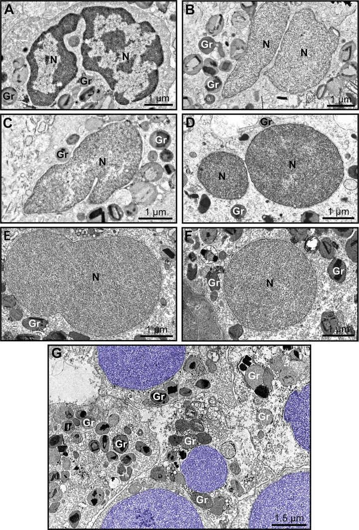 Early ultrastructural signs of eosinophil ETosis (EETosis): a representative intact eosinophil with bilobed nucleus (N), specific granules (SG) with preserved crystalloid core (CC), and early ETosis showing irregular nuclear profile and altered granule distribution.