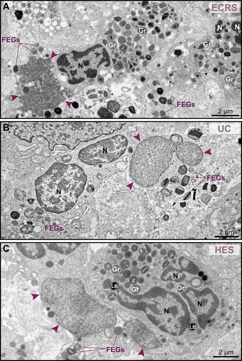 Tissue eosinophils undergoing ETosis in inflammatory sites, in proximity of intact eosinophils. Electron micrographs of biopsy samples from patients with eosinophil-associated diseases, showing EETosis (eosinophil extracellular trap cell death) in tissue.