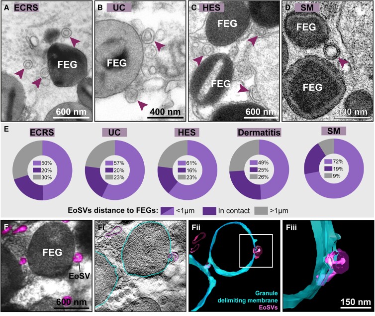 Extracellular sombrero vesicles associate with FEGs in inflamed tissues. (A-D) Representative electron micrographs showing intact extracellular EoSVs (arrowheads) around or in contact with FEGs in different inflamed tissues of eosinophilic diseases.