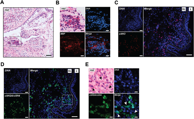 EETs rich in citrullination are abundantly present in human ECRS tissue. (A) A representative image of nasal polyp tissue stained with hematoxylin and eosin (H&E). (B) Increased magnification of selected area from A representing H&E stain, DNA (blue), and major basic protein (MBP; red). (C) Immunofluorescence images showing DNA (blue) and citrullinated histone H3 (citH3; red). (D) Immunofluorescence images from the same section as shown in (C) with DNA (blue) and CIT-013 epitope citrullinated histone H2A (citH2A) and citH4 (green). (E) Increased magnification of selected area from (D) representing H&E stain, DNA (blue), and citH2A and citH4 (green). White arrowheads indicate CIT-013 epitope colocalization with diffuse extracellular DNA, while black arrowheads indicate the colocalization of diffused extracellular DNA with the observed presence of eosinophils. Scale bars in A, C and D are 50 um and in B and E are 10 um. SL, Sublining; L, Lining.