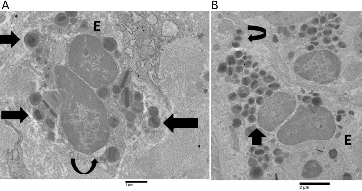 Ultrastructural images of human eosinophils showing non-ETotic cytolysis and early extracellular trap cell death (ETosis). A) A non-ETotic cytolytic eosinophil (E) in patient 1 exhibits a localized expansion of the nuclear envelope (curved arrow), moderately decondensed chromatin, and free extracellular granules (FEGs) (arrows); B) the early ETotic eosinophil (E) in patient 4 shows a notable dilatation of the perinuclear space (arrow), extensively decondensed chromatin, and FEGs (curved arrow)
